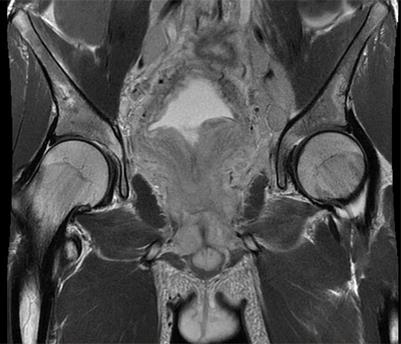 Case report: Lymph node metastasis of pelvic alveolar rhabdomyosarcoma diagnosed by fine needle aspiration cytology